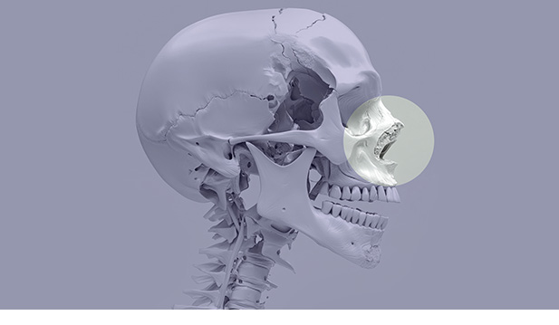 비골 골절 이미지
